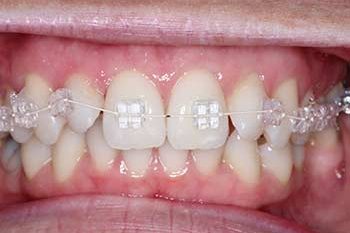 adult braces orthodontics carshalton sutton