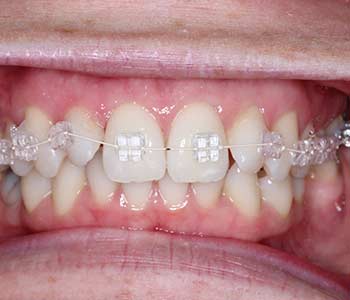 adult braces orthodontics carshalton sutton adult braces orthodontics carshalton sutton