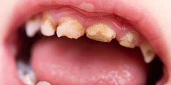 10 Reasons Children Have A High Decay Rate And What We Can Do About It 10 Reasons Children Have A High Decay Rate And What We Can Do About It