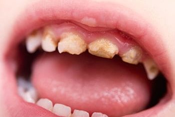 10 Reasons Children Have A High Decay Rate And What We Can Do About It 10 Reasons Children Have A High Decay Rate And What We Can Do About It