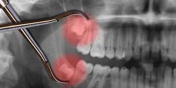 Everything You Need To Know About Problems With Wisdom Teeth Everything You Need To Know About Problems With Wisdom Teeth
