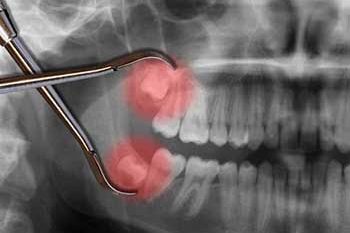 Everything You Need To Know About Problems With Wisdom Teeth Everything You Need To Know About Problems With Wisdom Teeth
