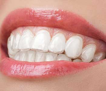 bright white teeth in sutton bright white teeth in sutton