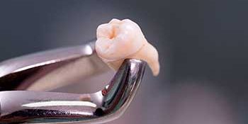 tooth extraction steps sutton tooth extraction steps sutton