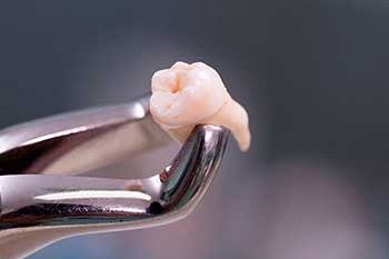 tooth extraction steps sutton tooth extraction steps sutton