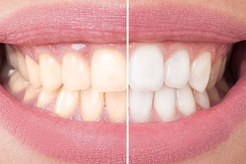 teeth whitening dentist sutton teeth whitening dentist sutton