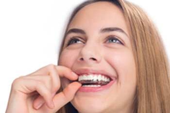 Looking For A Discreet Orthodontic Alternative To Braces Looking For A Discreet Orthodontic Alternative To Braces
