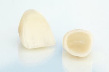 replacing old crowns surrey replacing old crowns surrey