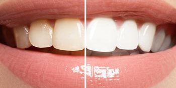 causes of staining on teeth and bleaching carshalton sutton causes of staining on teeth and bleaching carshalton sutton