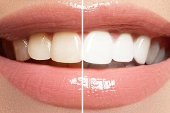 causes of staining on teeth and bleaching carshalton sutton causes of staining on teeth and bleaching carshalton sutton