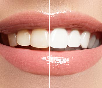 causes of staining on teeth and bleaching carshalton sutton causes of staining on teeth and bleaching carshalton sutton
