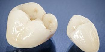 faqs about crowns carshalton sutton