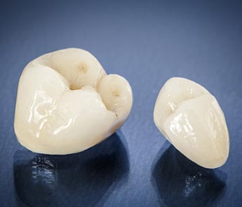 Dental crowns – your questions answered