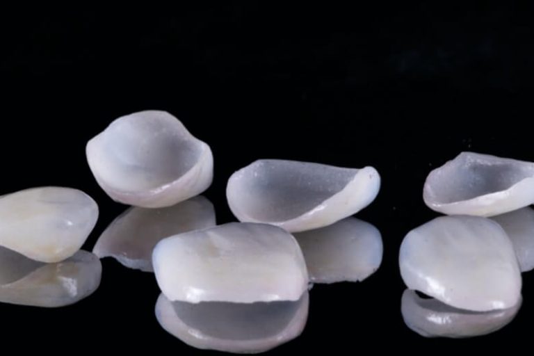 Sensational Smiles veneers 1 Sensational Smiles veneers 1