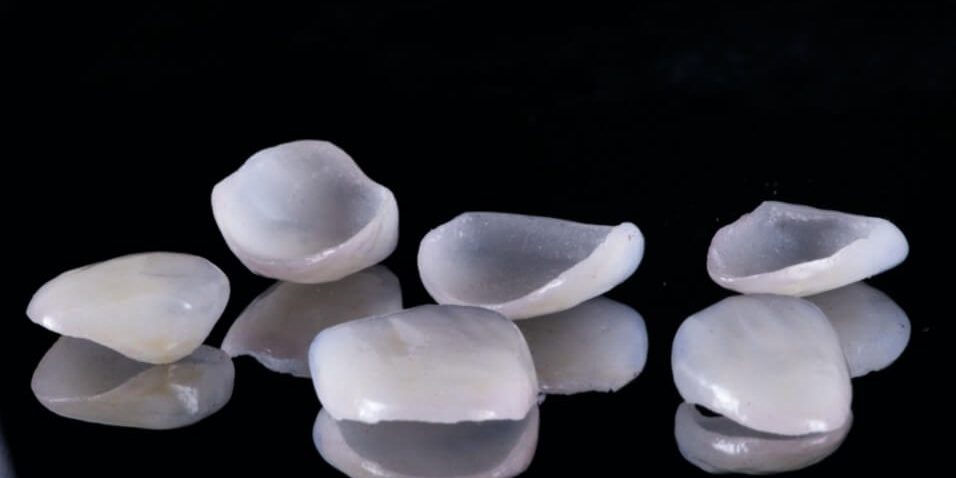 Sensational Smiles veneers 1 Sensational Smiles veneers 1