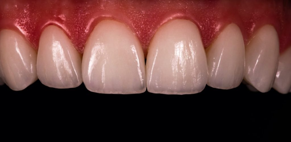 Sensational Smiles veneers