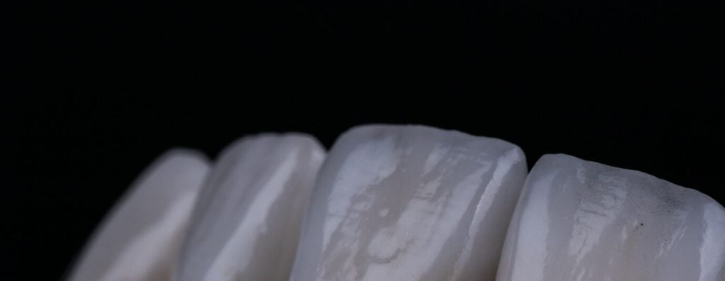 Sensational Smiles veneers