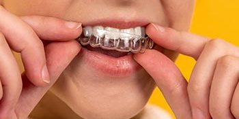 invisalign invisalign
