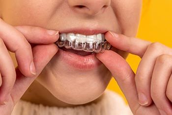 invisalign invisalign