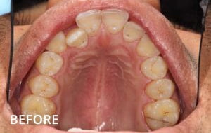 orthodontics case 1 before