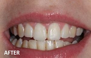 orthodontics case 2 after