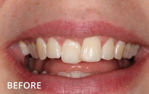 orthodontics case 2 before