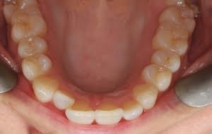 teeth straightening 1 before