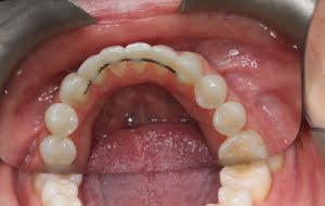 teeth straightening 2 after