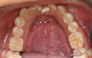 teeth straightening 2 before