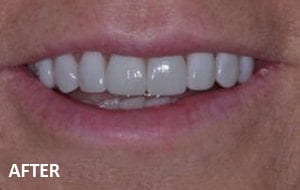 veneers case 2 after