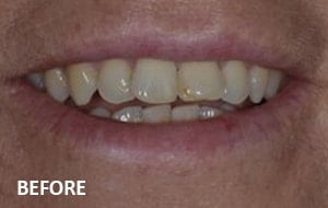 veneers case 2 before