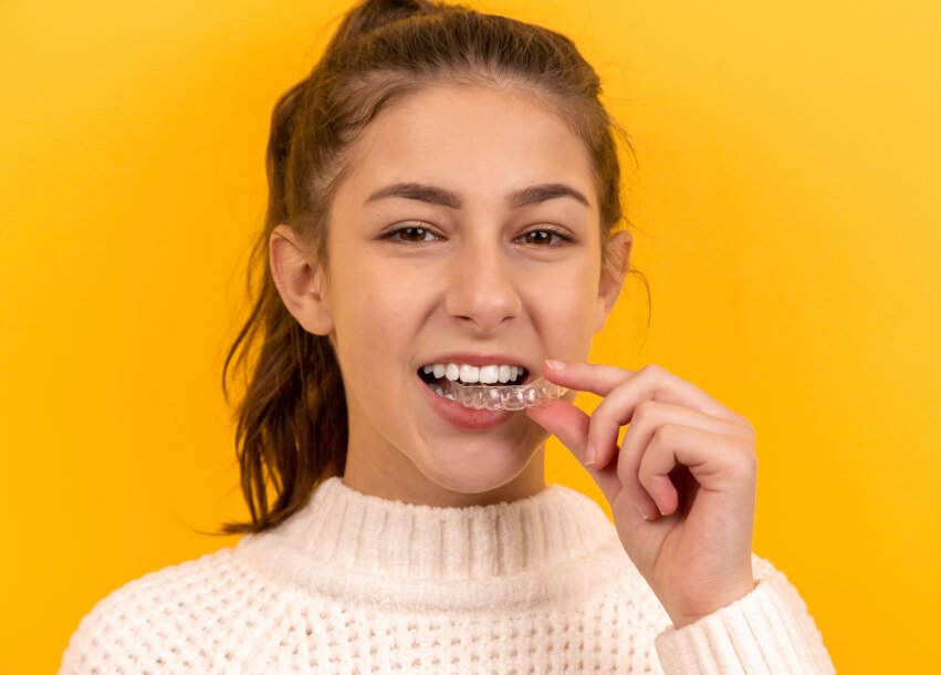How to put rubber bands on Invisalign aligners