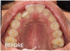 orthodontics before1