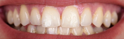 tooth-whitening-inner-image-before