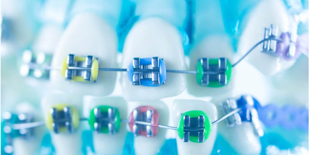 types of braces for teeth types of braces for teeth