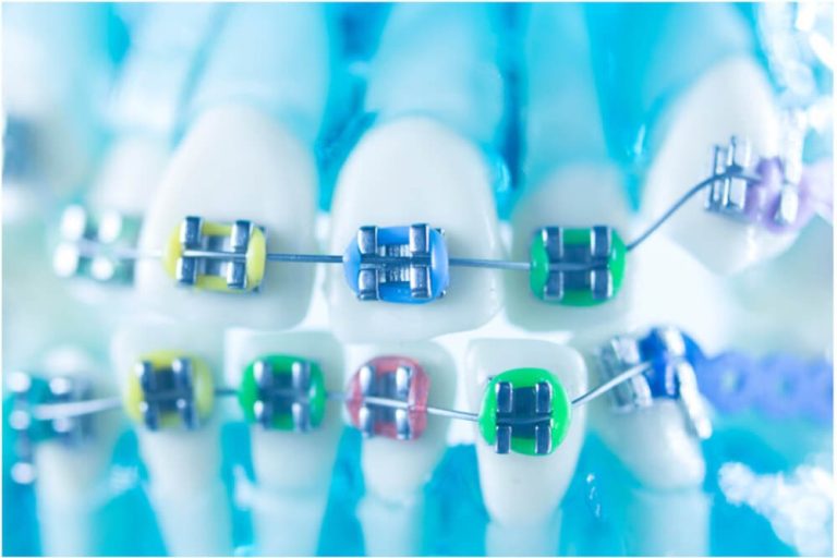 types of braces for teeth types of braces for teeth