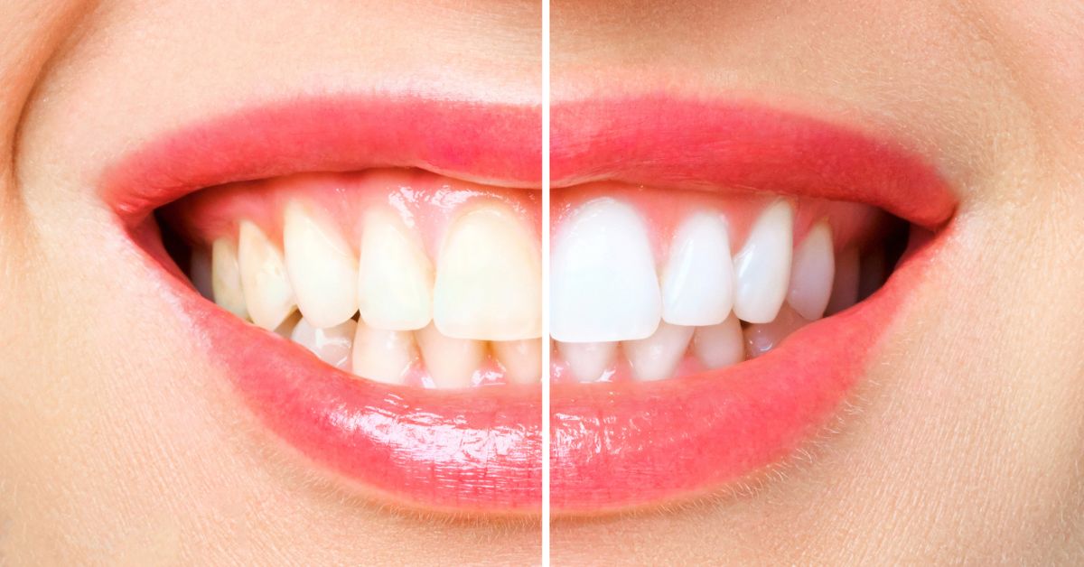 Teeth whitening