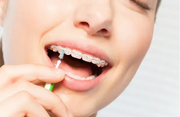 How to Clean Your Teeth with Braces