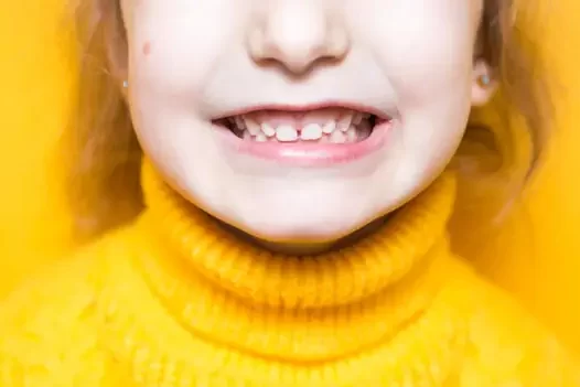 What Causes An Overbite What Causes An Overbite