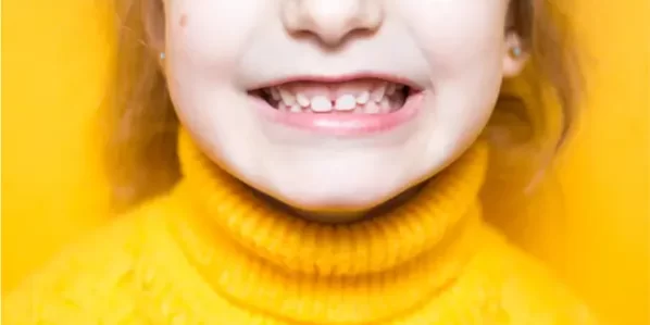 What Causes An Overbite