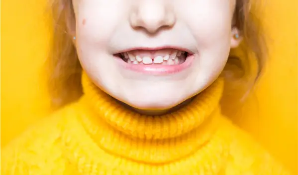 What Causes An Overbite What Causes An Overbite