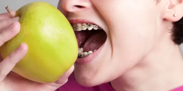What You Can and Cant Eat With Braces